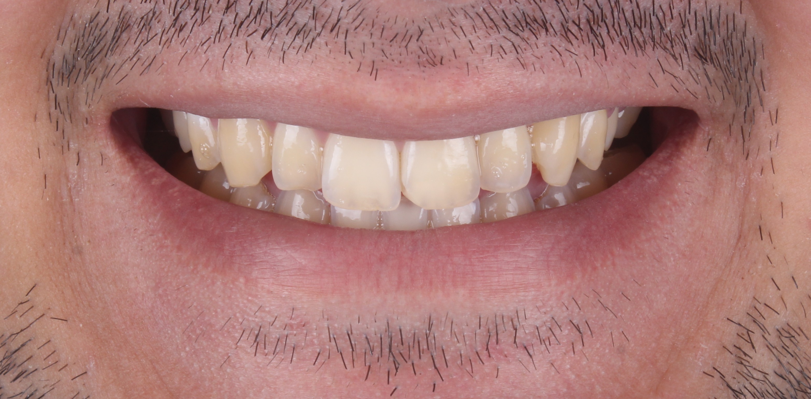 Antes do clareamento dental